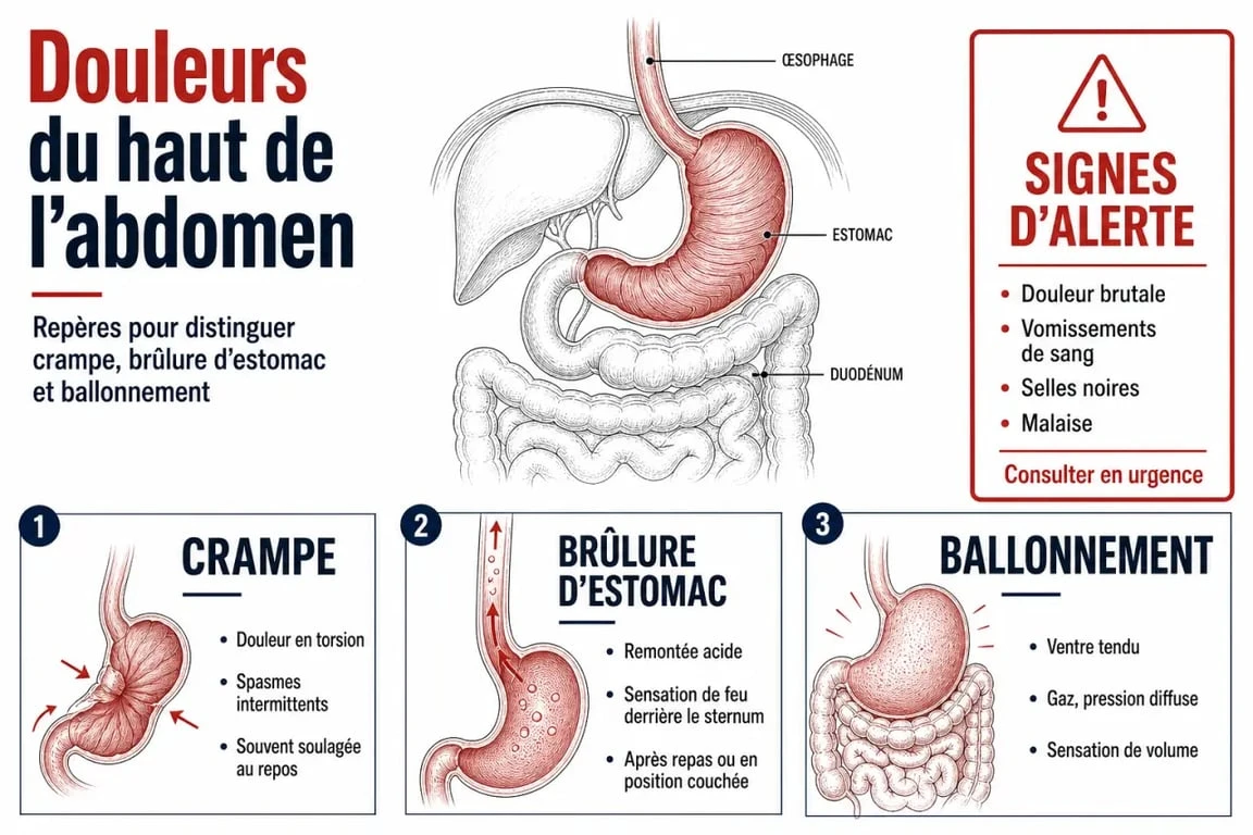 crampe estomac que faire : comparaison visuelle entre crampe, brûlure et ballonnement avec signes d’alerte